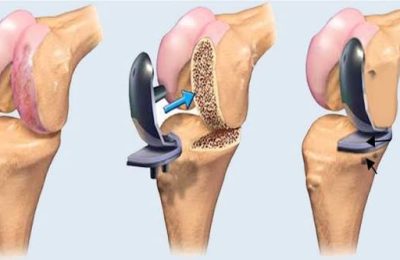 Joint Replacement Chandigarh: Enhanced Treatments for Painless Mobility