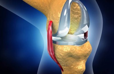 Joint Replacement Surgery Goa: Options for Restoring Freedom of Movement