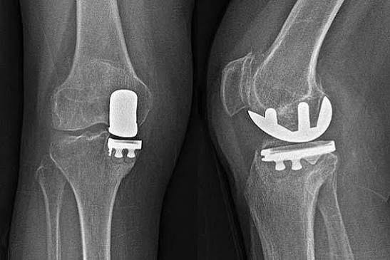 Partial Knee Replacement Mohali